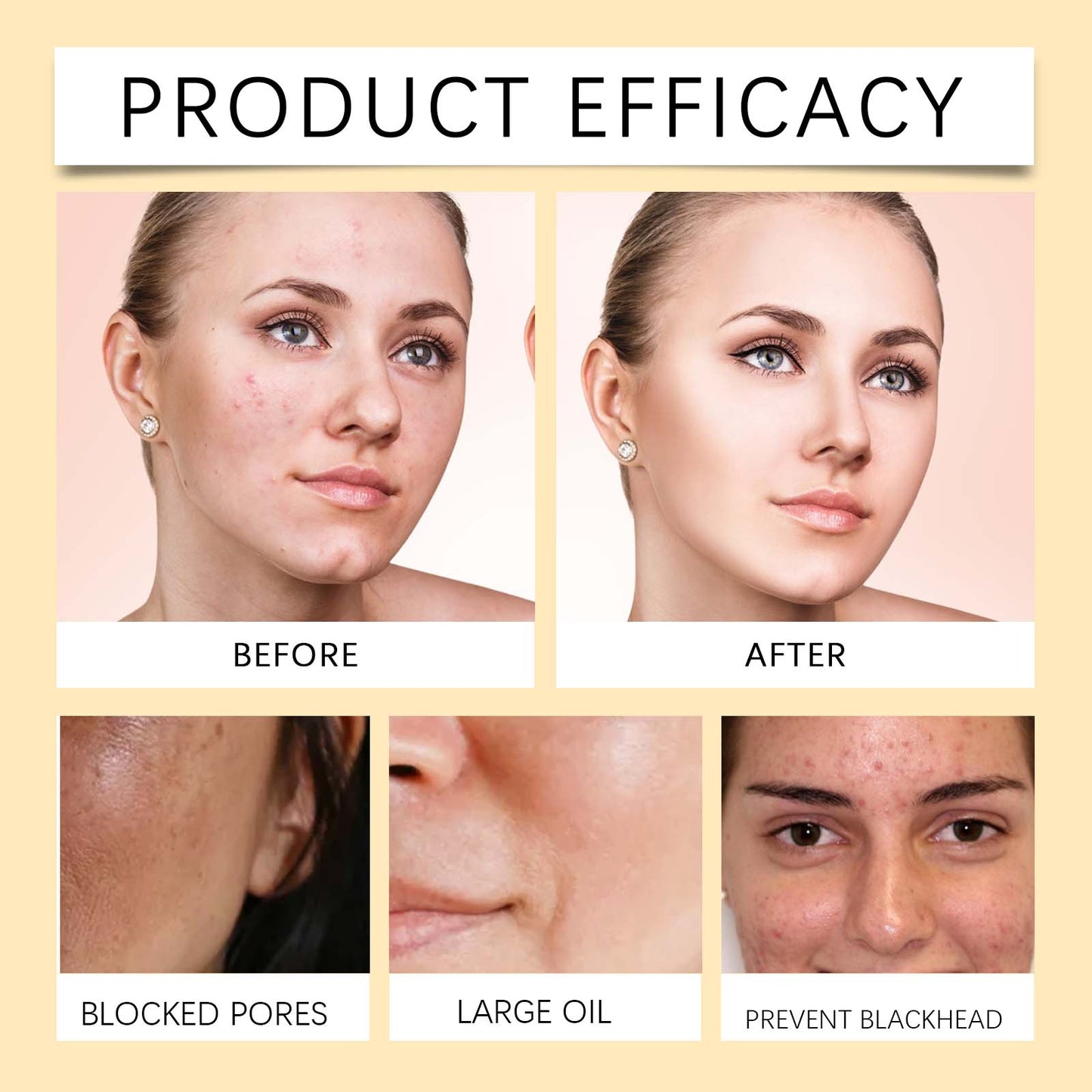 EELHOE Glycolic Acid 7% Toner - Anti-Acne Exfoliating Toner, Gently Fights Blemishes & Clogged Pores, Brightening & Hydrating for All Skin Types