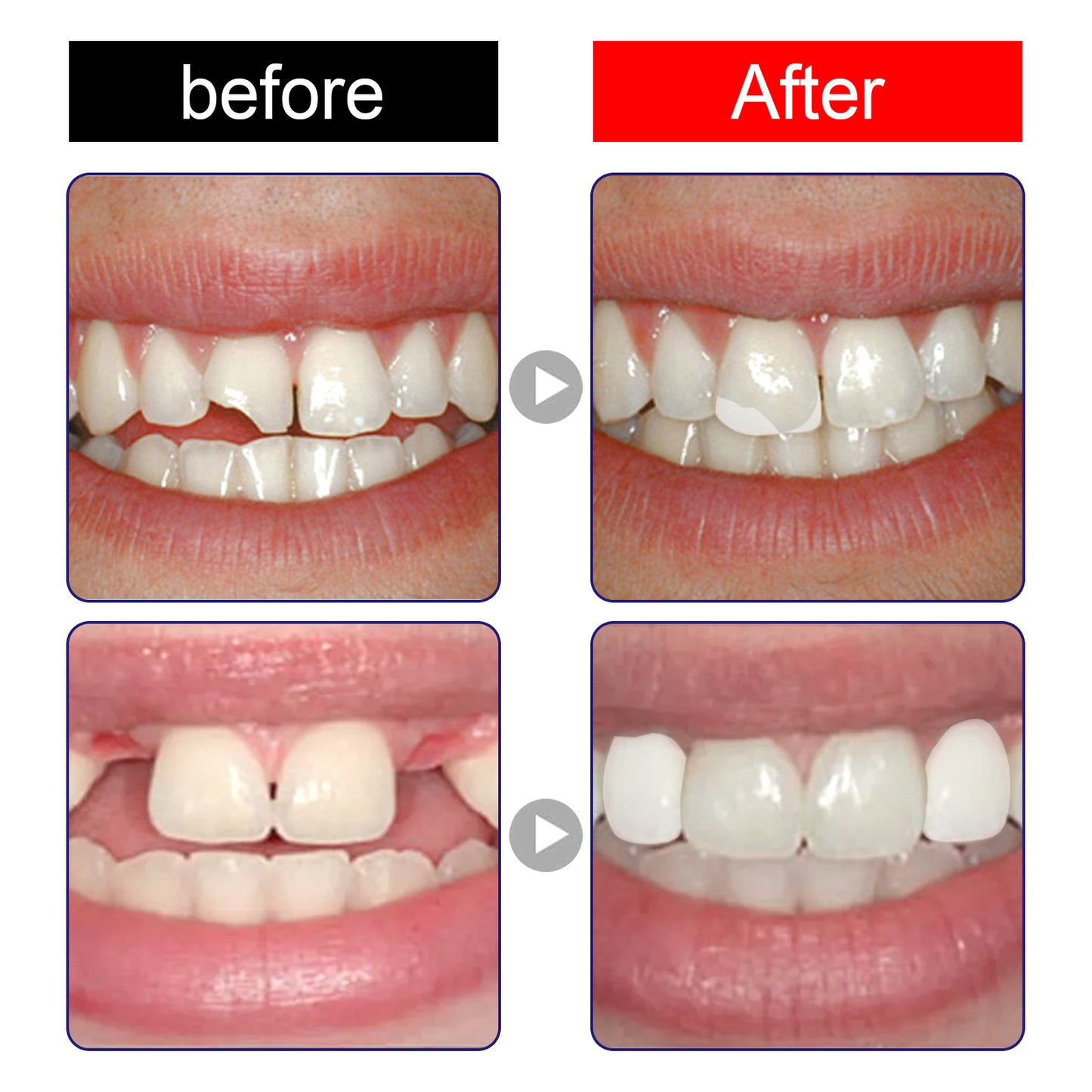 Jaysuing Temporary Tooth Repair Kit - Moldable Filling & Cap for Lost Fillings or Chipped Teeth, Dental Emergency Kit, Cosmetic Use